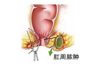 肛周膿腫最新手術(shù)方法，探索與解析